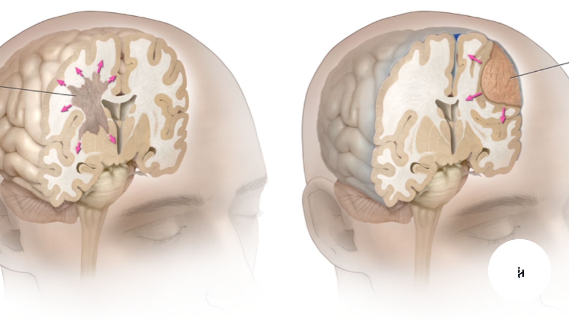 Glioma