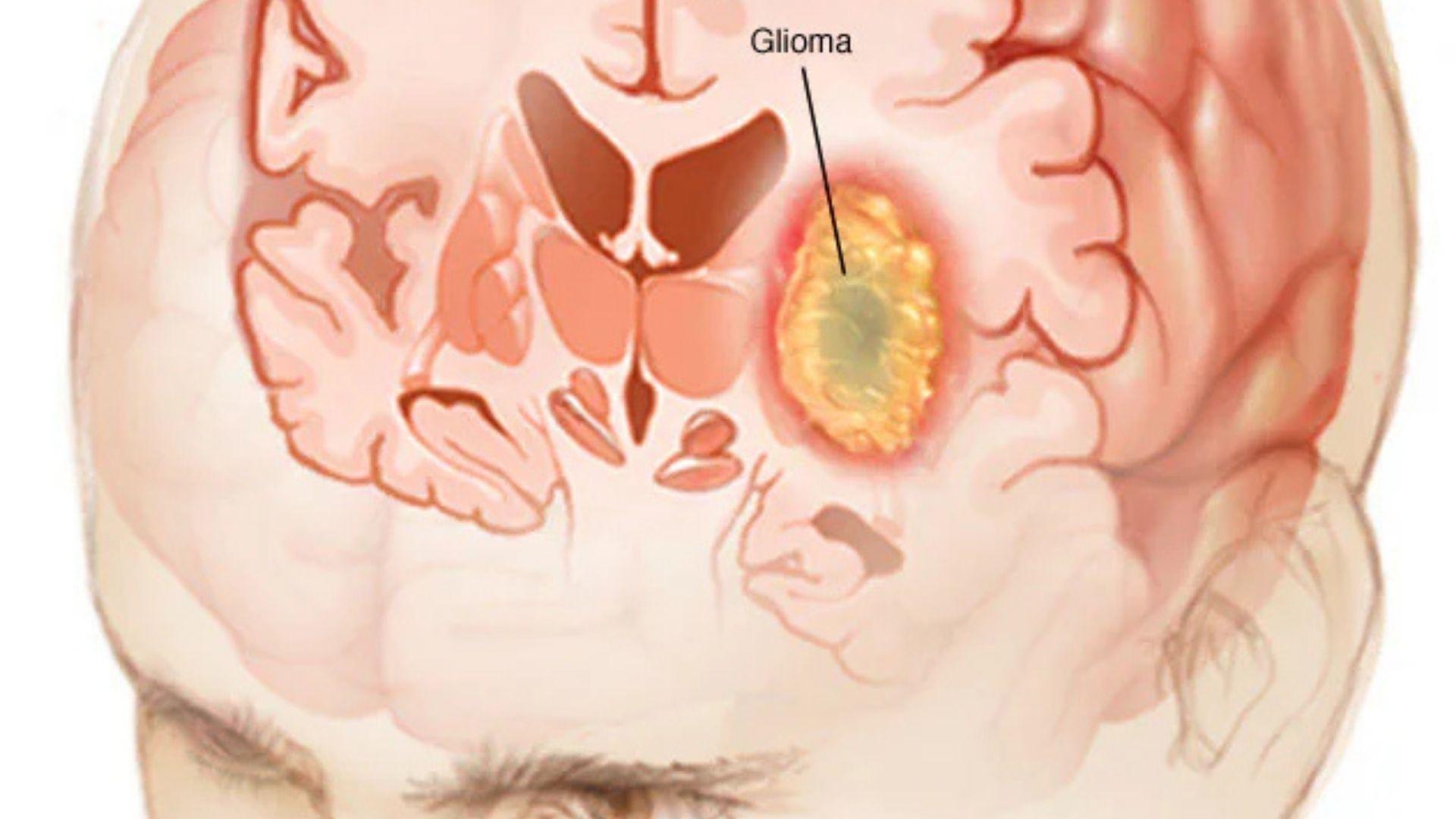 Glioma