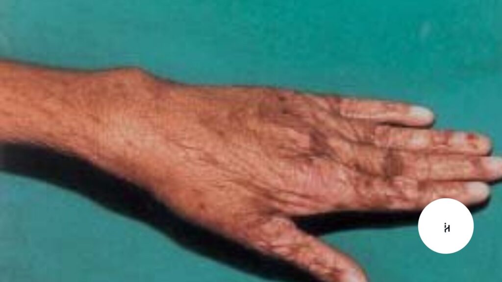 Paper Skin Disease