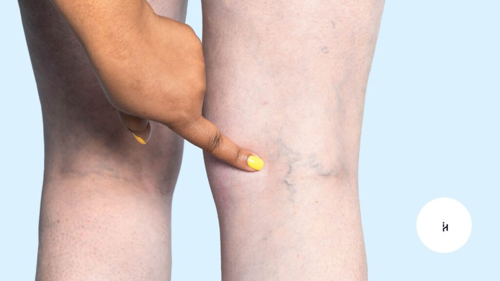 Chronic Venous Insufficiency